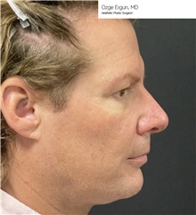 Facial Implants Before Photo by Ozge Ergun, MD; Istanbul, C - Case 49803