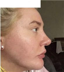 Facial Implants After Photo by Ozge Ergun, MD; Istanbul, C - Case 49804