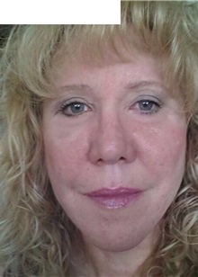 Facelift After Photo by Ozge Ergun, MD; Istanbul, C - Case 49812