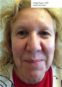 Facelift Before Photo by Ozge Ergun, MD; Istanbul, C - Case 49812