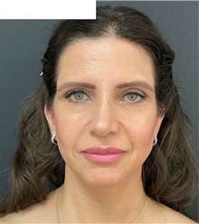 Facelift After Photo by Ozge Ergun, MD; Istanbul, C - Case 49807