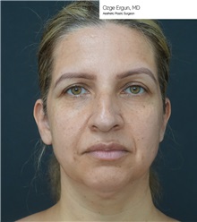 Facelift Before Photo by Ozge Ergun, MD; Istanbul, C - Case 49807
