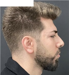 Chin Augmentation After Photo by Ozge Ergun, MD; Istanbul, C - Case 49798