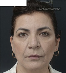 Eyelid Surgery After Photo by Ozge Ergun, MD; Istanbul, C - Case 49814