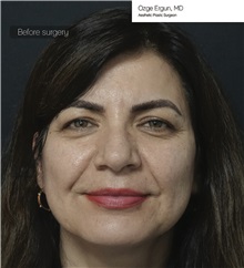 Eyelid Surgery Before Photo by Ozge Ergun, MD; Istanbul, C - Case 49814