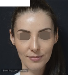 Chin Augmentation After Photo by Ozge Ergun, MD; Istanbul, C - Case 49799