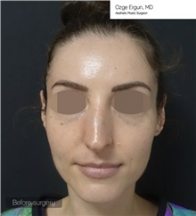 Chin Augmentation Before Photo by Ozge Ergun, MD; Istanbul, C - Case 49799