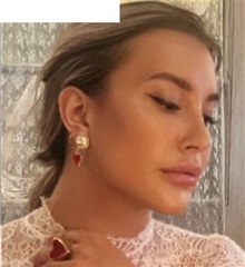 Facial Implants After Photo by Ozge Ergun, MD; Istanbul, C - Case 49805