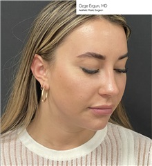 Facial Implants Before Photo by Ozge Ergun, MD; Istanbul, C - Case 49805