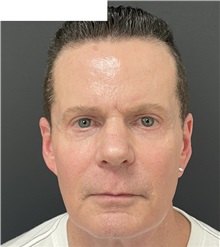 Eyelid Surgery After Photo by Ozge Ergun, MD; Istanbul, C - Case 49813