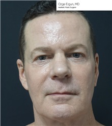 Eyelid Surgery Before Photo by Ozge Ergun, MD; Istanbul, C - Case 49813