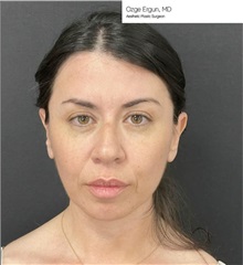 Facelift Before Photo by Ozge Ergun, MD; Istanbul, C - Case 49809