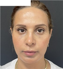Facelift After Photo by Ozge Ergun, MD; Istanbul, C - Case 49810