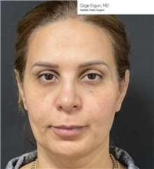 Facelift Before Photo by Ozge Ergun, MD; Istanbul, C - Case 49810
