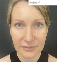 Facelift Before Photo by Ozge Ergun, MD; Istanbul, C - Case 49811 Facelift Before Photo by Ozge Ergun, MD; Istanbul, C - Case 49811