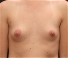 Breast Augmentation Before Photo by Laurie Casas, MD FACS; Glenview, IL - Case 25492