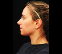 Rhinoplasty After Photo by Laurie Casas, MD FACS; Glenview, IL - Case 25504