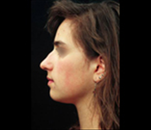Rhinoplasty Before Photo by Laurie Casas, MD FACS; Glenview, IL - Case 25504