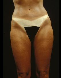 Liposuction After Photo by Laurie Casas, MD FACS; Glenview, IL - Case 3330