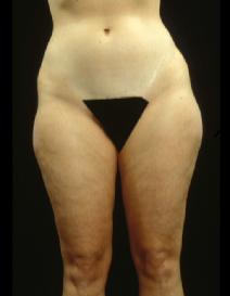 Liposuction Before Photo by Laurie Casas, MD FACS; Glenview, IL - Case 3330