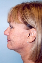 Facelift After Photo by Kristoffer Ning Chang, MD; San Francisco, CA - Case 10335