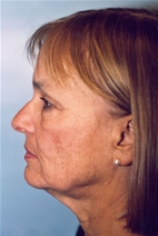 Facelift Before Photo by Kristoffer Ning Chang, MD; San Francisco, CA - Case 10335