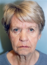 Facelift Before Photo by Kristoffer Ning Chang, MD; San Francisco, CA - Case 10339