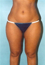 Liposuction Before Photo by Kristoffer Ning Chang, MD; San Francisco, CA - Case 10342