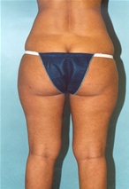 Liposuction Before Photo by Kristoffer Ning Chang, MD; San Francisco, CA - Case 10342