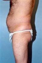 Liposuction Before Photo by Kristoffer Ning Chang, MD; San Francisco, CA - Case 10345