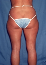 Liposuction Before Photo by Kristoffer Ning Chang, MD; San Francisco, CA - Case 10348