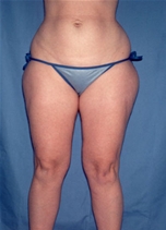 Liposuction Before Photo by Kristoffer Ning Chang, MD; San Francisco, CA - Case 10349