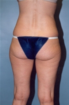 Liposuction Before Photo by Kristoffer Ning Chang, MD; San Francisco, CA - Case 10353