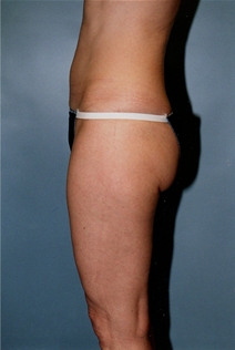Liposuction Before Photo by Kristoffer Ning Chang, MD; San Francisco, CA - Case 10353