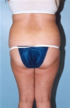 Liposuction Before Photo by Kristoffer Ning Chang, MD; San Francisco, CA - Case 10354