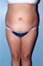 Liposuction Before Photo by Kristoffer Ning Chang, MD; San Francisco, CA - Case 10355