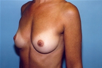 Breast Augmentation Before Photo by Kristoffer Ning Chang, MD; San Francisco, CA - Case 10356