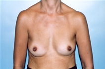 Breast Augmentation Before Photo by Kristoffer Ning Chang, MD; San Francisco, CA - Case 10357