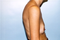 Breast Augmentation Before Photo by Kristoffer Ning Chang, MD; San Francisco, CA - Case 10357