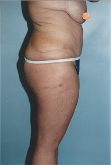 Tummy Tuck After Photo by Kristoffer Ning Chang, MD; San Francisco, CA - Case 10358