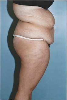 Tummy Tuck Before Photo by Kristoffer Ning Chang, MD; San Francisco, CA - Case 10358