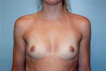 Breast Augmentation Before Photo by Kristoffer Ning Chang, MD; San Francisco, CA - Case 10359