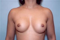 Breast Augmentation After Photo by Kristoffer Ning Chang, MD; San Francisco, CA - Case 10361