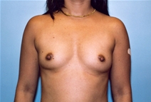 Breast Augmentation Before Photo by Kristoffer Ning Chang, MD; San Francisco, CA - Case 10361