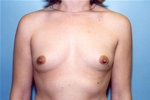 Breast Augmentation Before Photo by Kristoffer Ning Chang, MD; San Francisco, CA - Case 10366