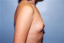 Breast Augmentation Before Photo by Kristoffer Ning Chang, MD; San Francisco, CA - Case 10366