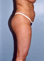 Liposuction Before Photo by Kristoffer Ning Chang, MD; San Francisco, CA - Case 10367