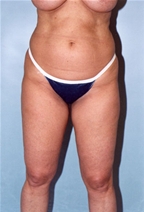 Liposuction Before Photo by Kristoffer Ning Chang, MD; San Francisco, CA - Case 10367