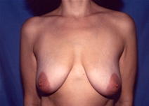 Breast Lift Before Photo by Kristoffer Ning Chang, MD; San Francisco, CA - Case 10386