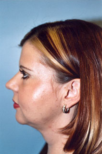 Facelift After Photo by Kristoffer Ning Chang, MD; San Francisco, CA - Case 10403
